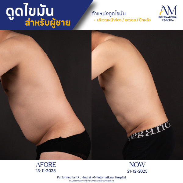 OP(ANGA)-รีวิวดูดไขมัน-ผู้ชาย-BA-09