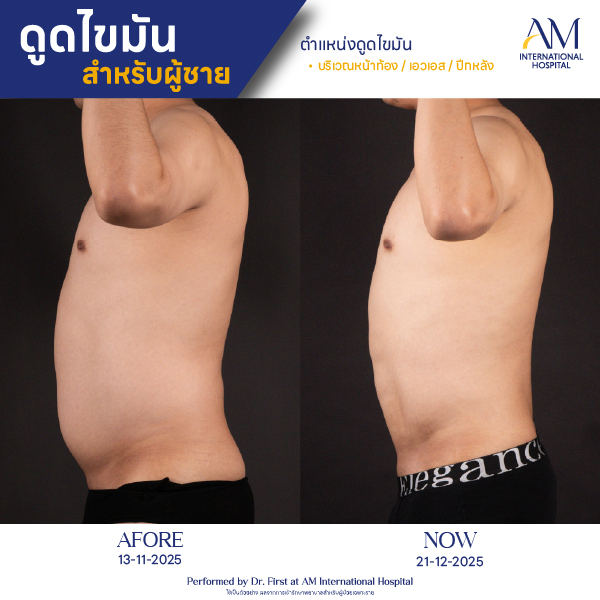 OP(ANGA)-รีวิวดูดไขมัน-ผู้ชาย-BA-10