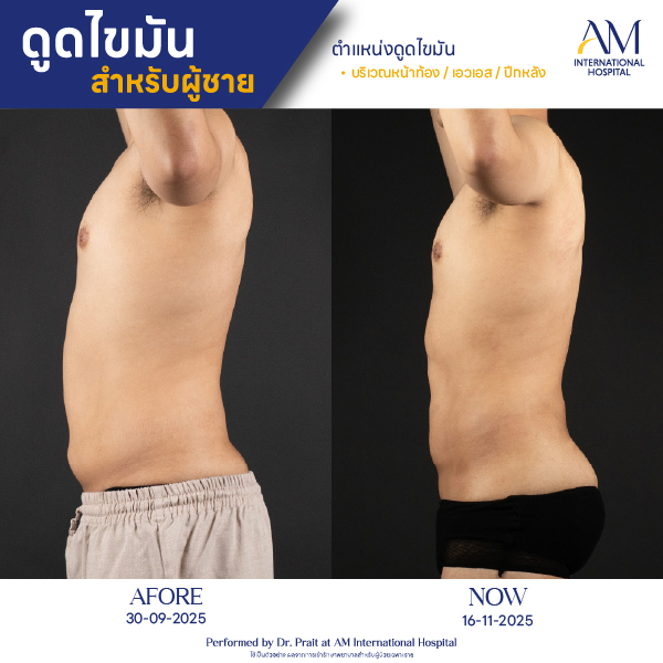 OP(ANGA)-รีวิวดูดไขมัน-ผู้ชาย-BA-11