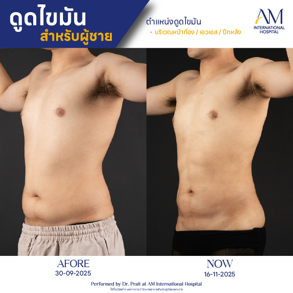 OP(ANGA)-รีวิวดูดไขมัน-ผู้ชาย-BA-12