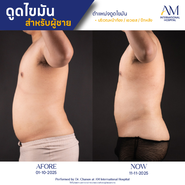 OP(ANGA)-รีวิวดูดไขมัน-ผู้ชาย-BA-13