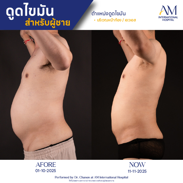 OP(ANGA)-รีวิวดูดไขมัน-ผู้ชาย-BA-14