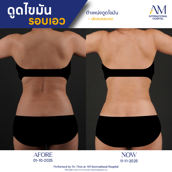 OP(ANGA)-รีวิวดูดไขมัน-เอว-BA-01