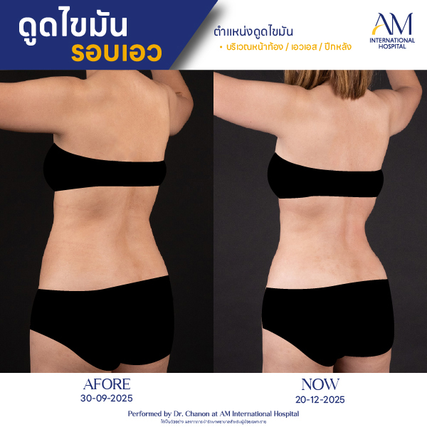 OP(ANGA)-รีวิวดูดไขมัน-เอว-BA-02