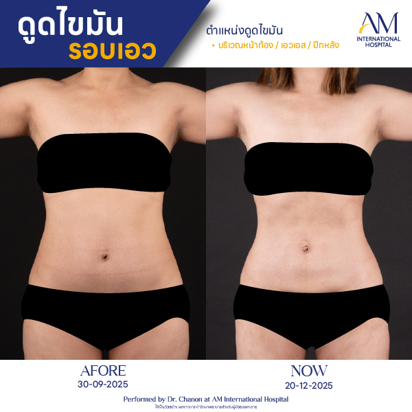 OP(ANGA)-รีวิวดูดไขมัน-เอว-BA-03