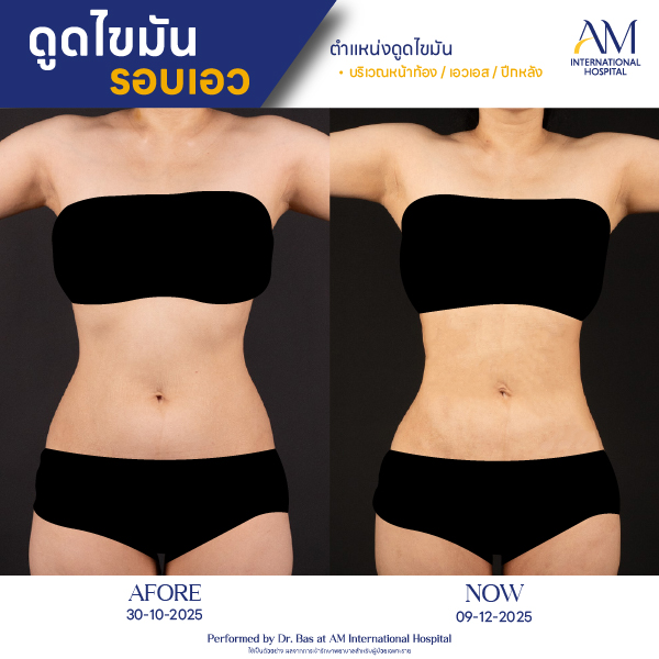 OP(ANGA)-รีวิวดูดไขมัน-เอว-BA-04