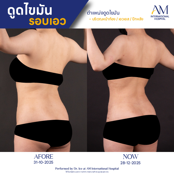 OP(ANGA)-รีวิวดูดไขมัน-เอว-BA-06