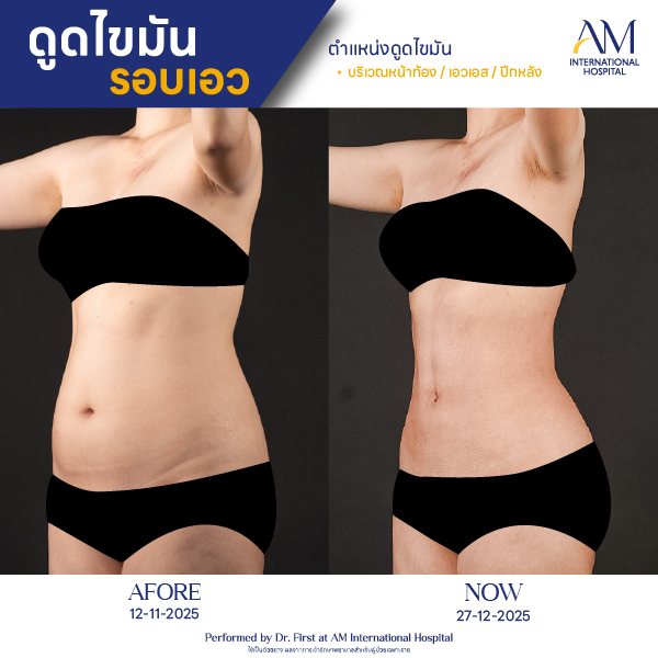 OP(ANGA)-รีวิวดูดไขมัน-เอว-BA-07