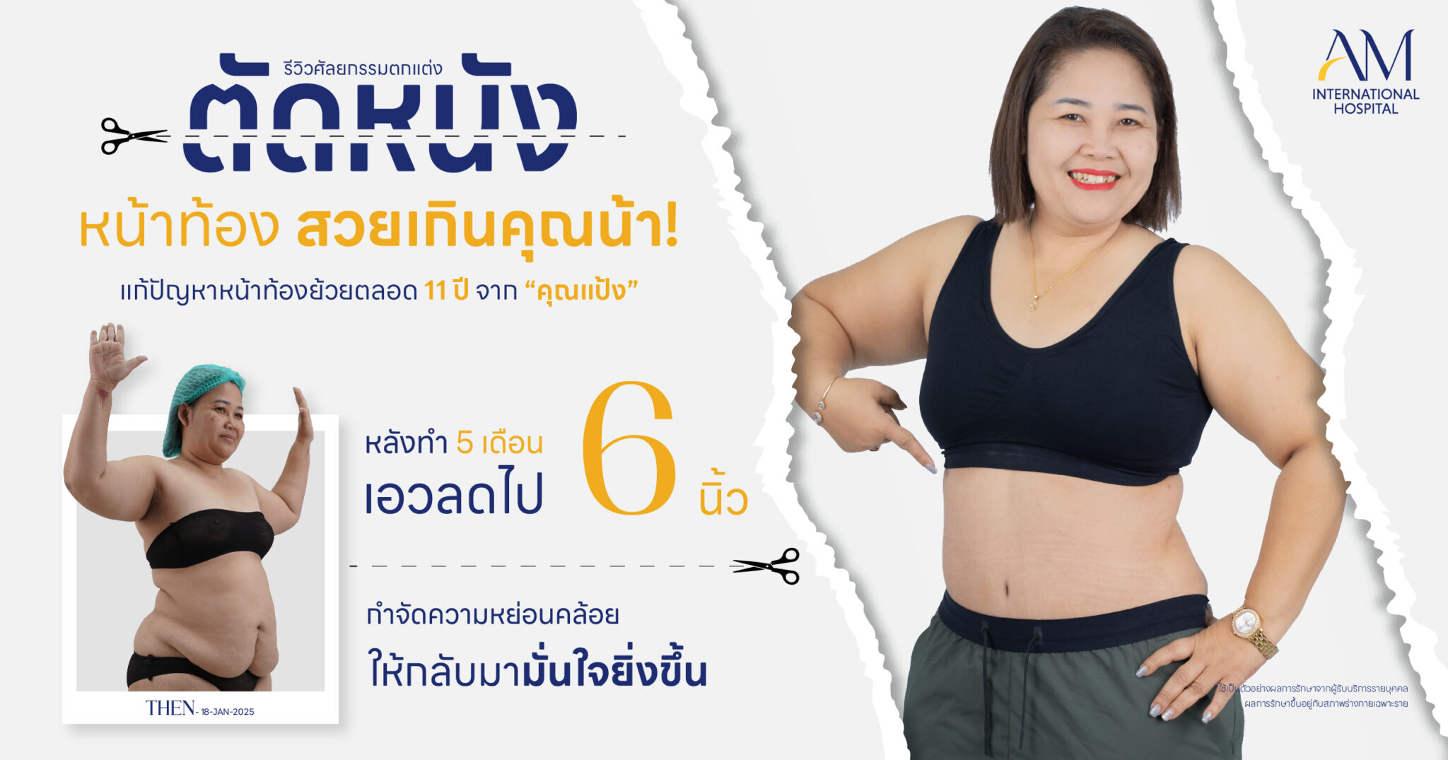 รีวิวตัดหนังหน้าท้อง