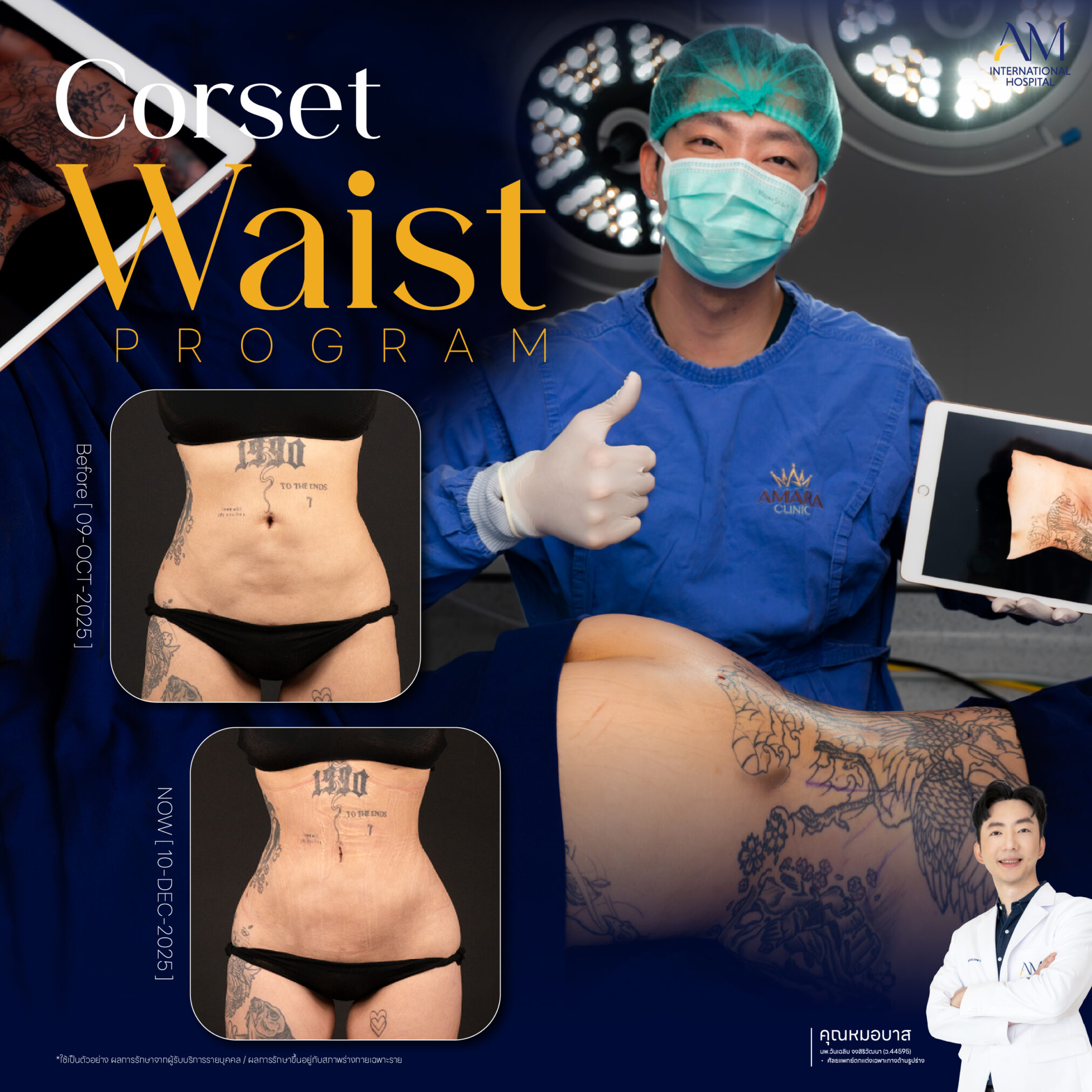 Corset Waist งอกระดูก เอวคอด