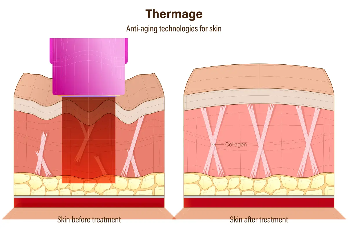 thermage คือ