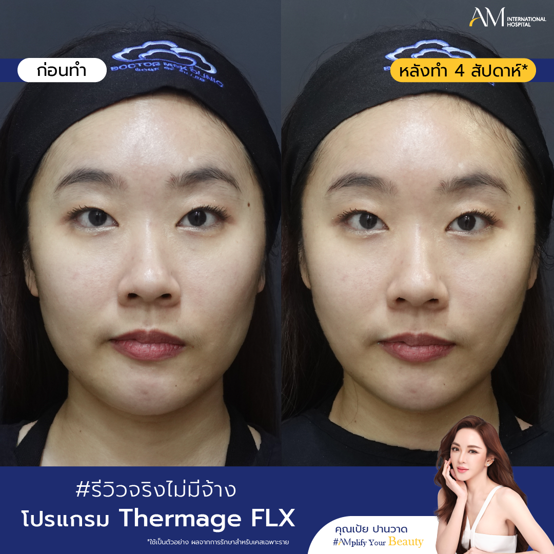 ก่อนและหลังทำโปรแกรม thermage เคสแก้มช่วงล่างหย่อนคล้อย