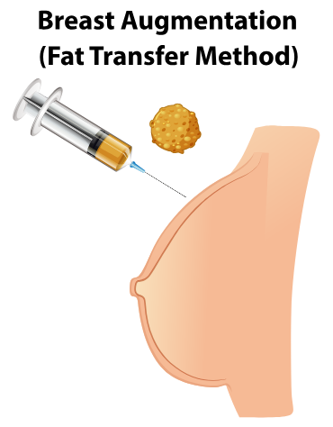 ฉีดไขมันหน้าอก