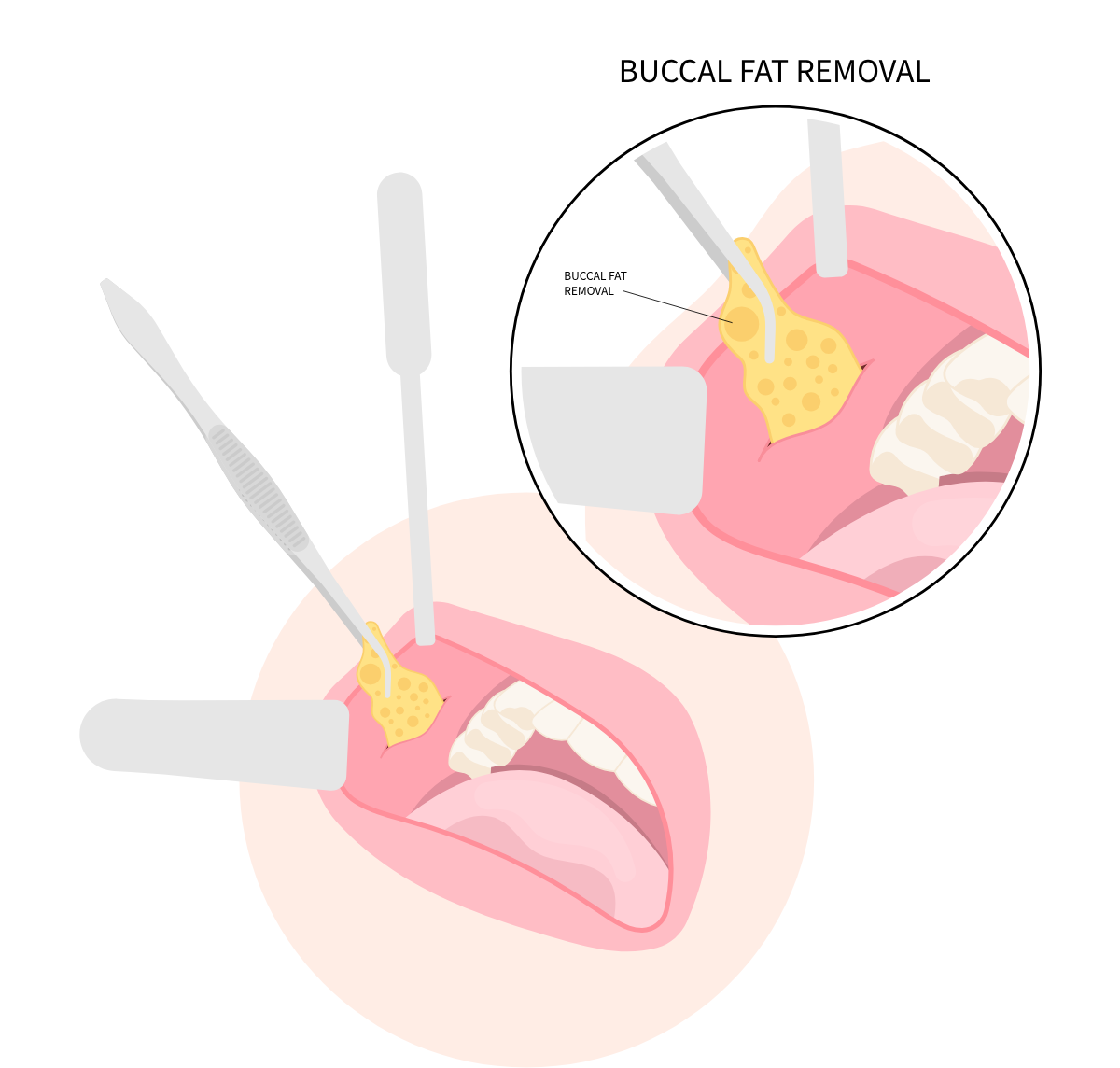 ตัดไขมันกระพุ้งแก้ม