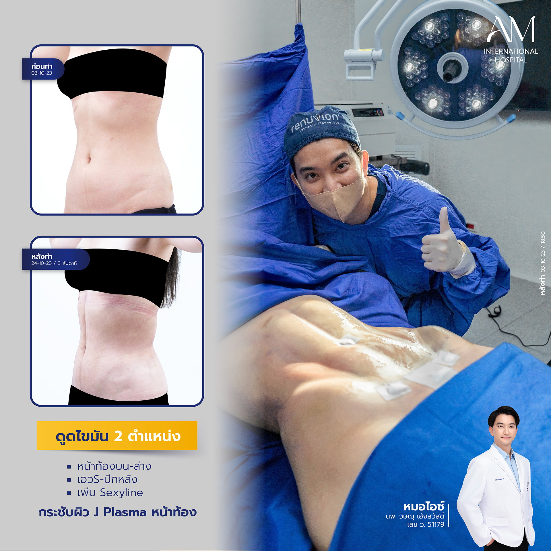 2024-02-14-สนใจดูดไขมัน-รีวิว
