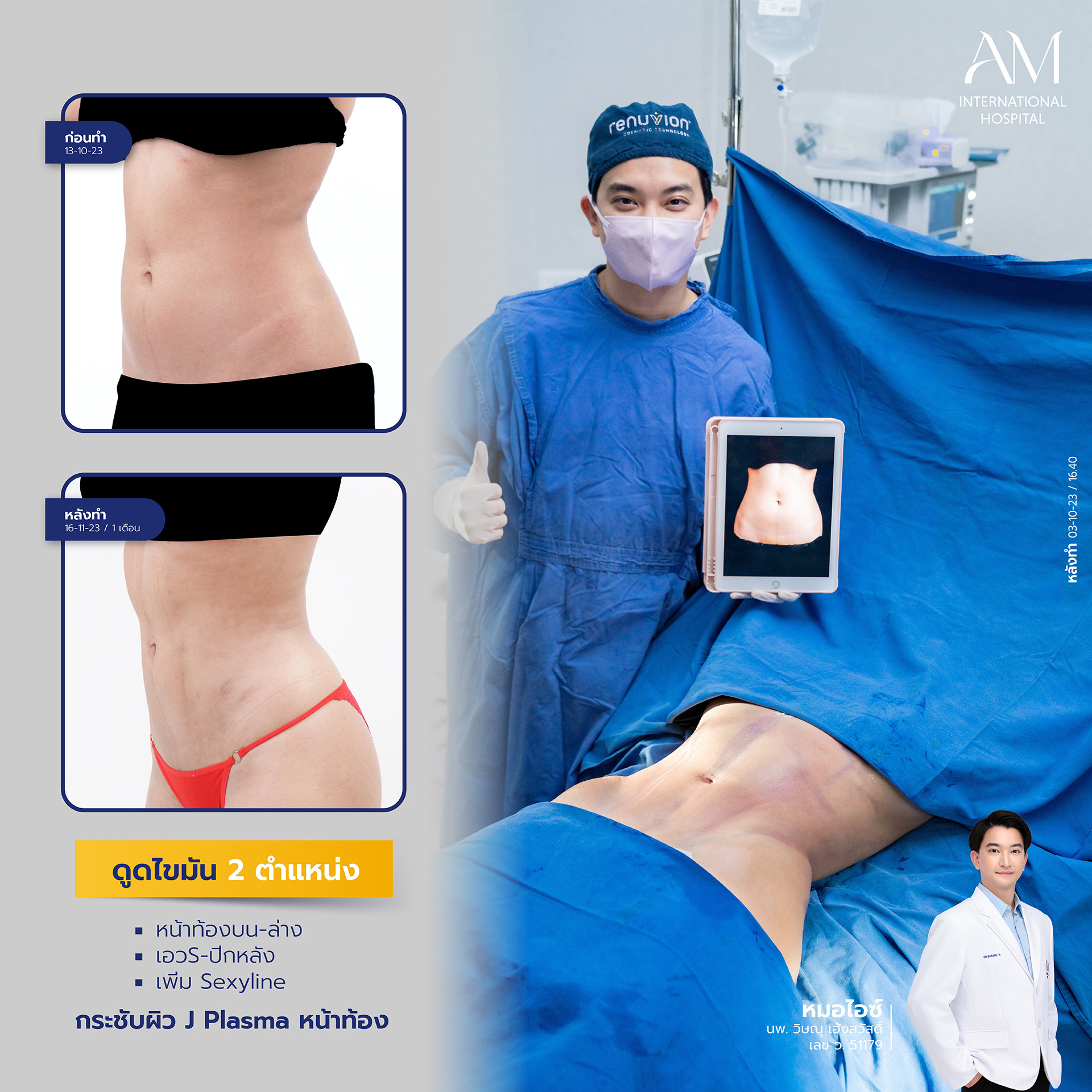 2024-02-14-สนใจดูดไขมัน-รีวิว
