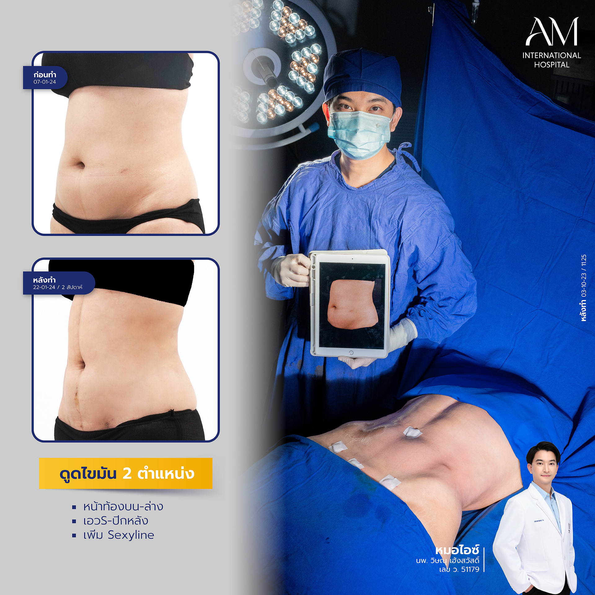 2024-02-14-สนใจดูดไขมัน-รีวิว