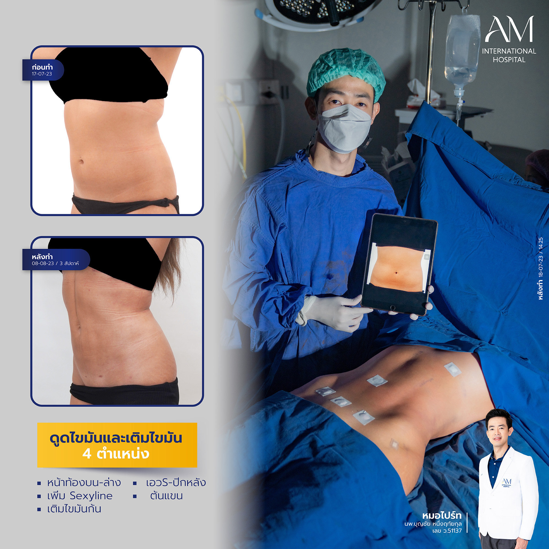 2024-02-14-สนใจดูดไขมัน-รีวิว