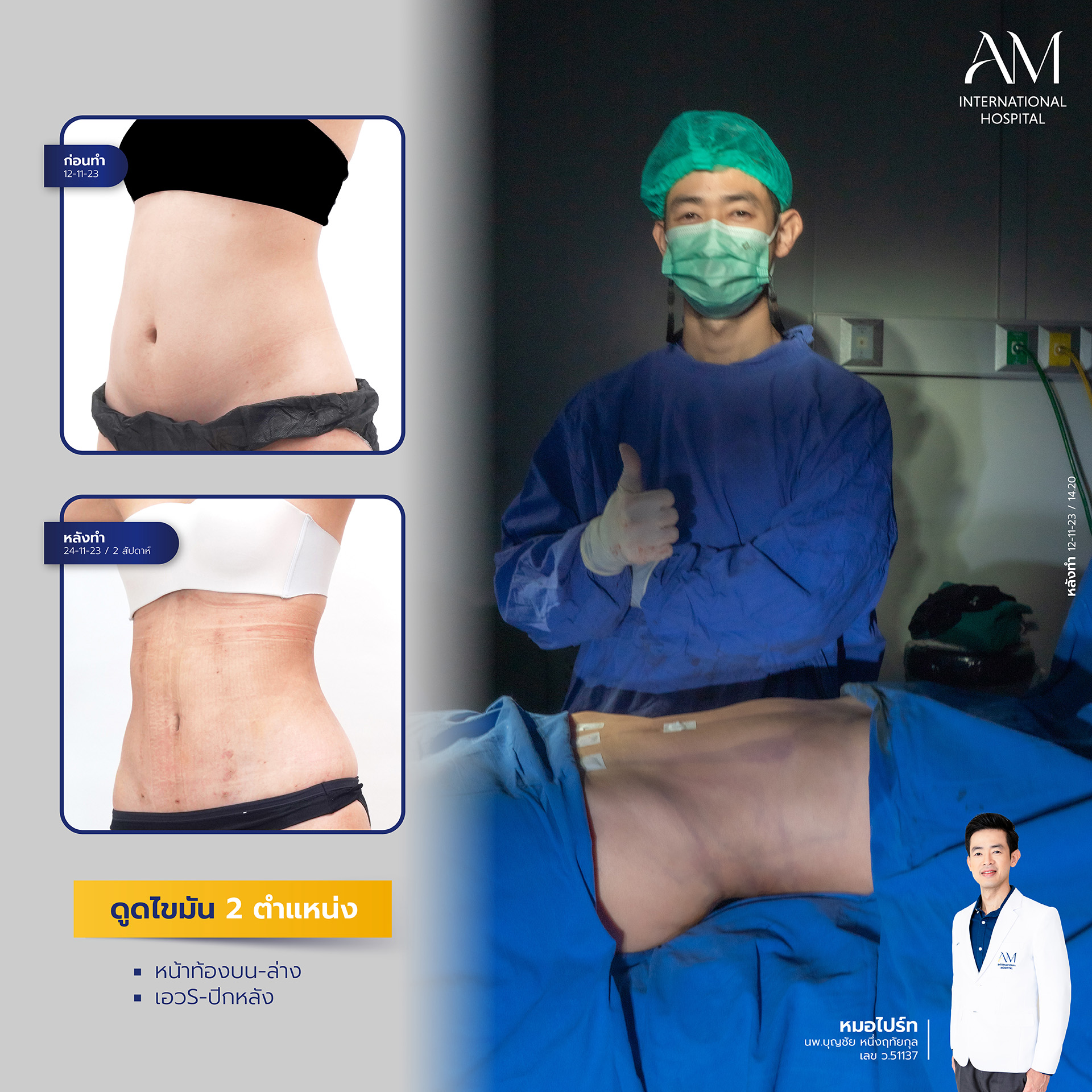 2024-02-14-สนใจดูดไขมัน-รีวิว