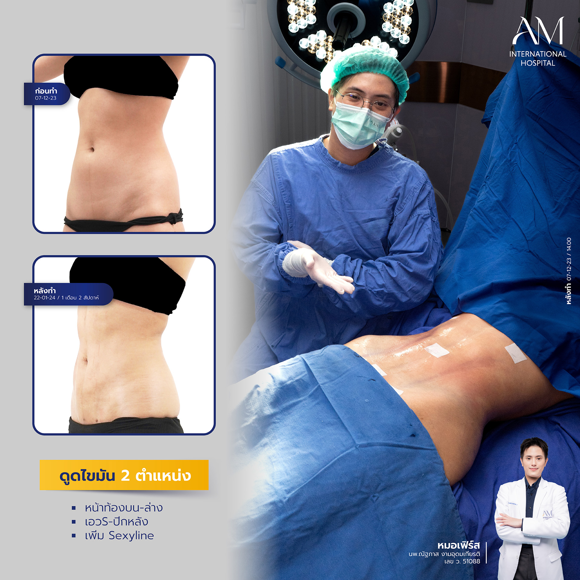 2024-02-14-สนใจดูดไขมัน-รีวิว