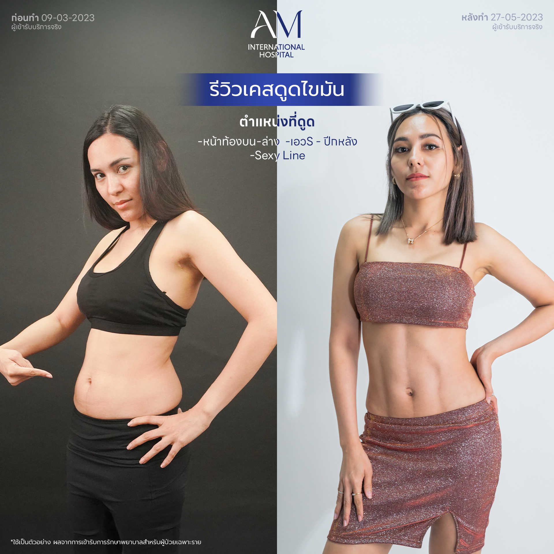ดูดไขมันที่ไหนดี พักฟื้นกี่วัน