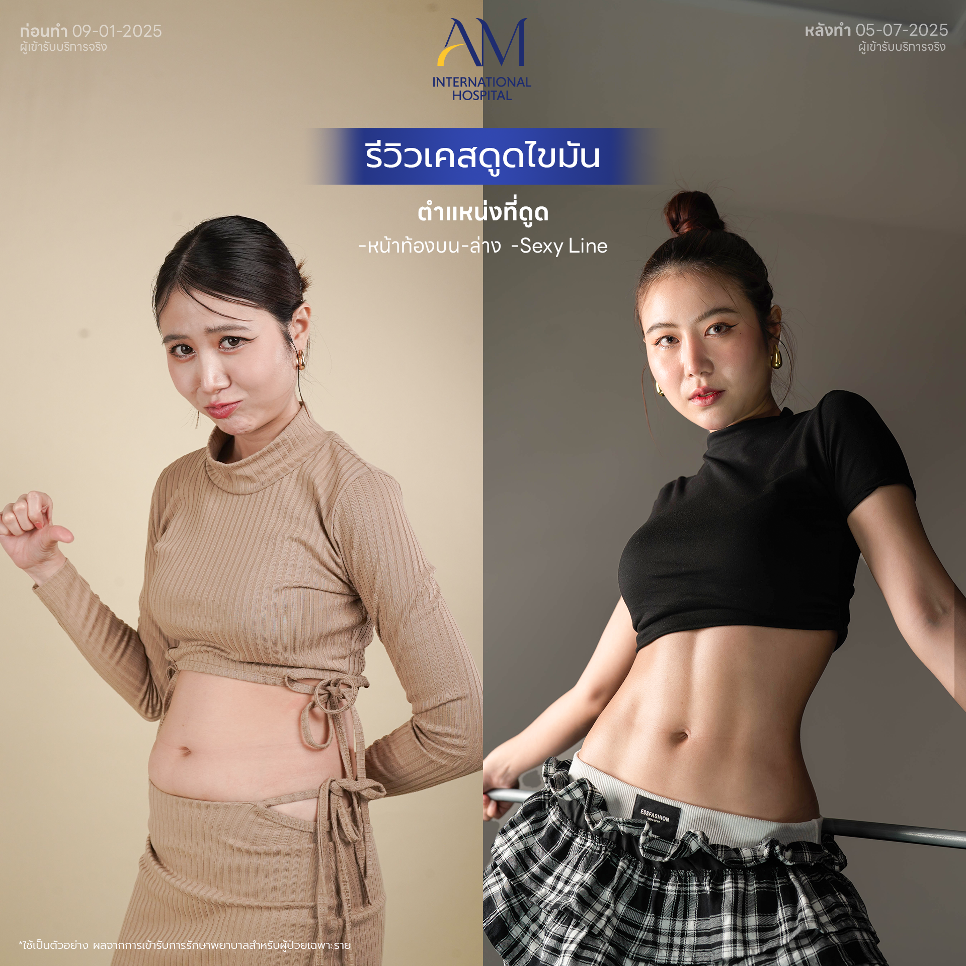ดูดไขมันที่ไหนดี ราคาดี