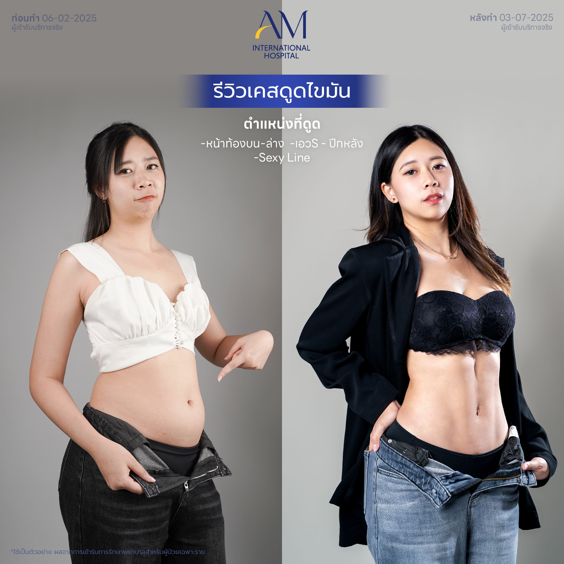 รีวิวดูดไขมัน