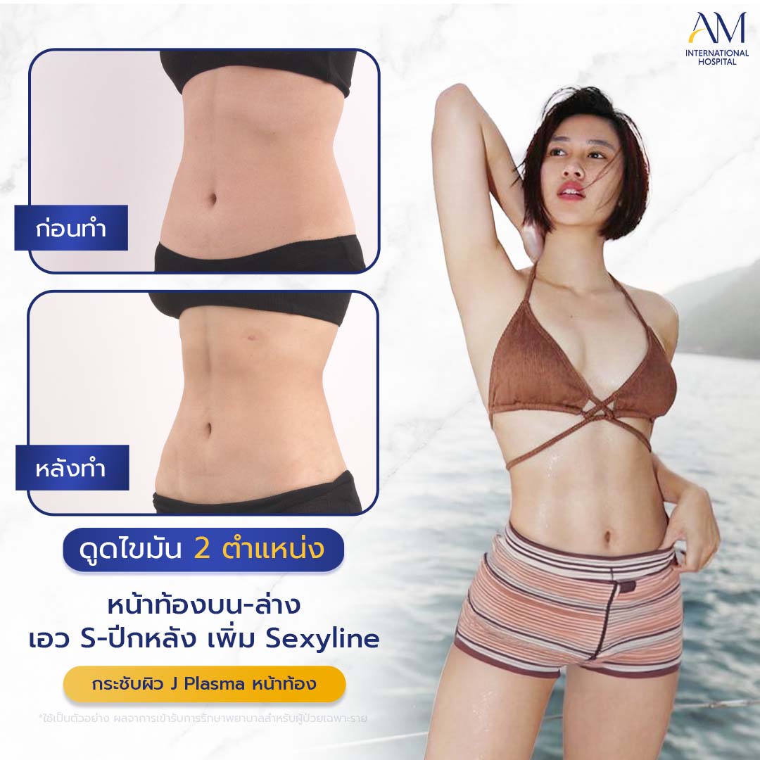 20260324-2024-02-14-สนใจดูดไขมัน-รีวิวโหด-Sexyline-Balloon2-แก้-1-1-1