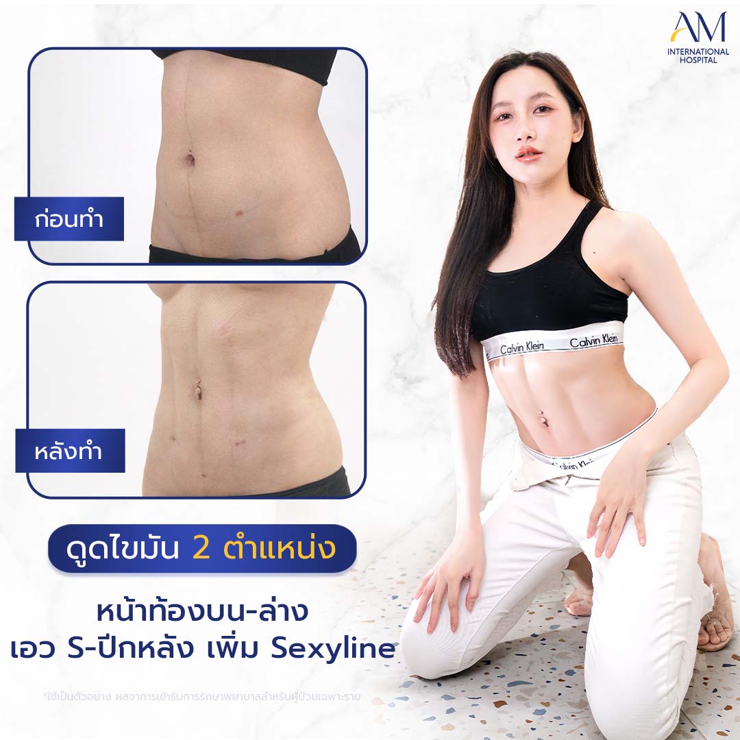 20260324-2024-02-14-สนใจดูดไขมัน-รีวิวโหด-Sexyline-Balloon2-แก้-1-1-4