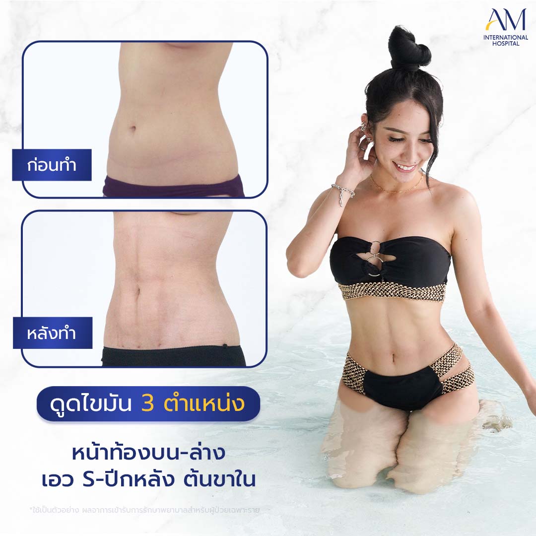 20260324-2024-02-14-สนใจดูดไขมัน-รีวิวโหด-Sexyline-Balloon2-แก้-1-1-5