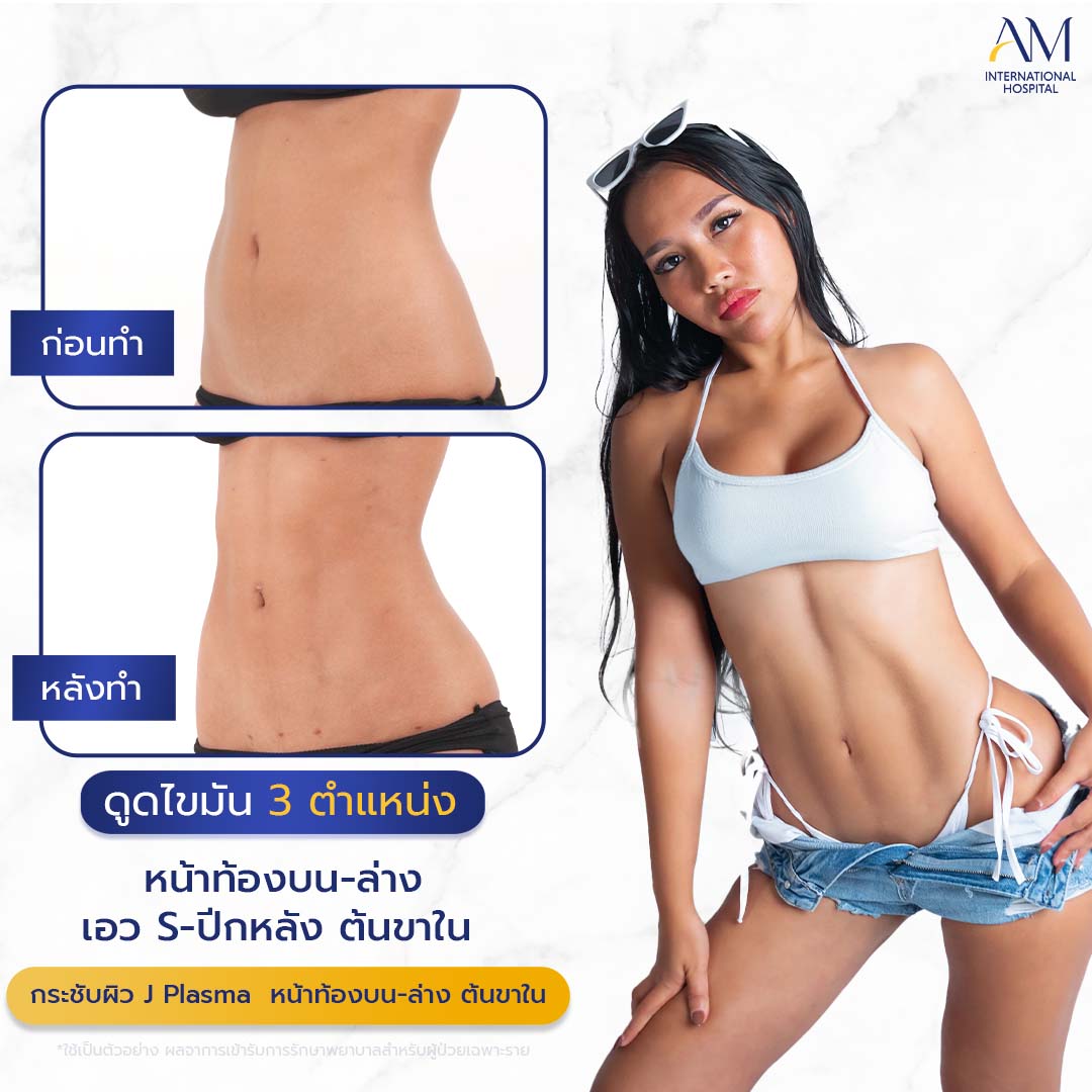 20260324-2024-02-14-สนใจดูดไขมัน-รีวิวโหด-Sexyline-Balloon2-แก้-1-1-6
