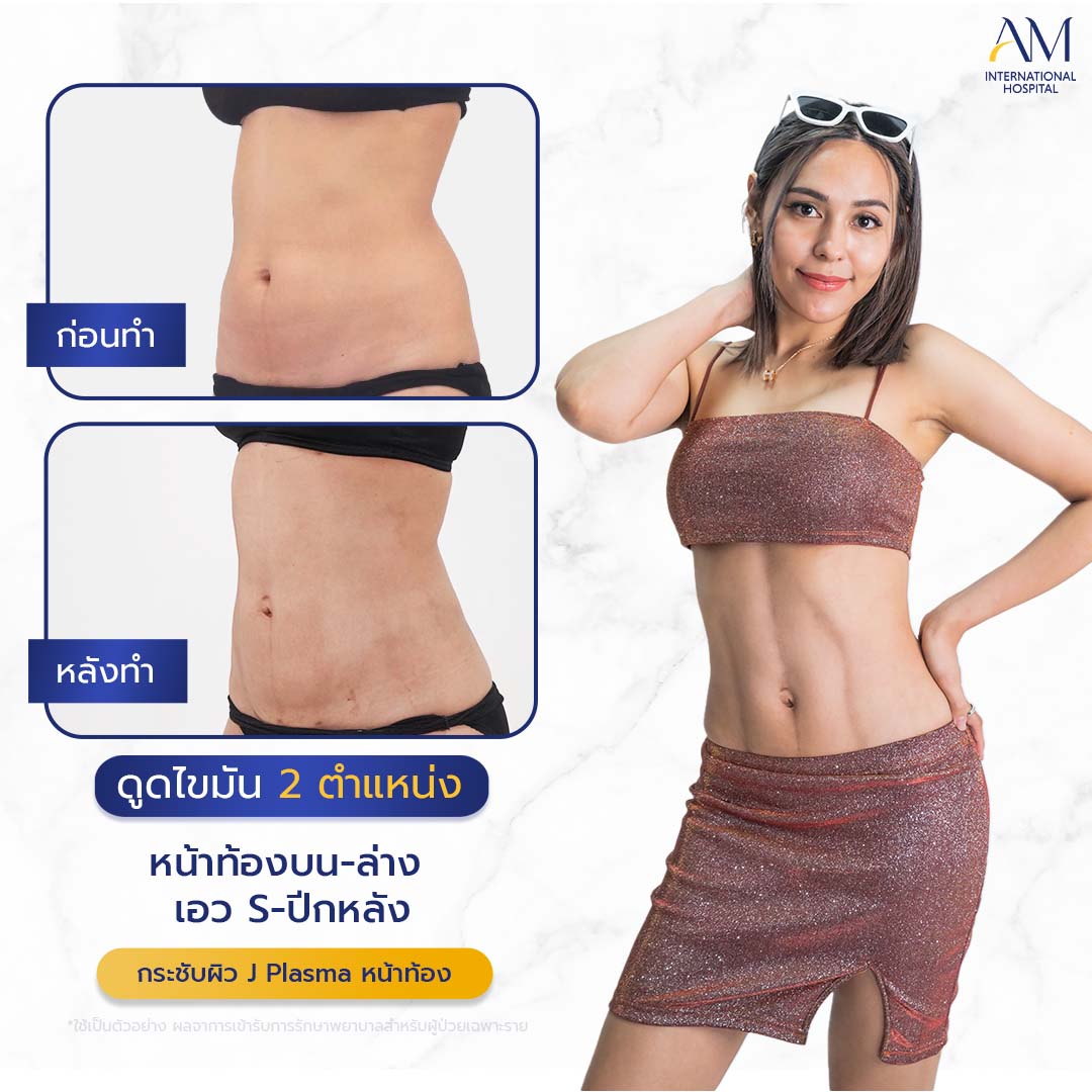 20260324-2024-02-14-สนใจดูดไขมัน-รีวิวโหด-Sexyline-Balloon2-แก้-1-1-7