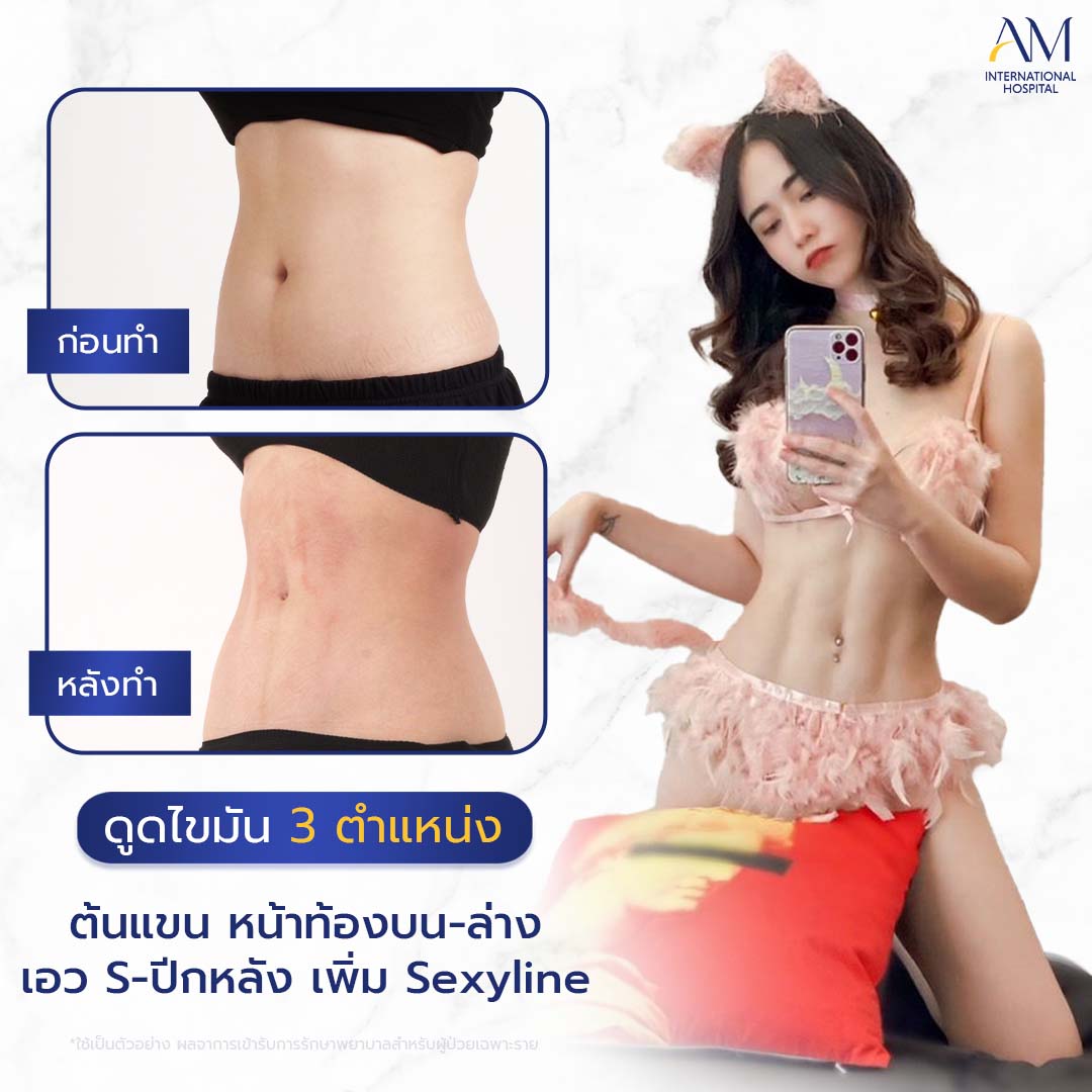 20260324-2024-02-14-สนใจดูดไขมัน-รีวิวโหด-Sexyline-Balloon2-แก้-1-1-8