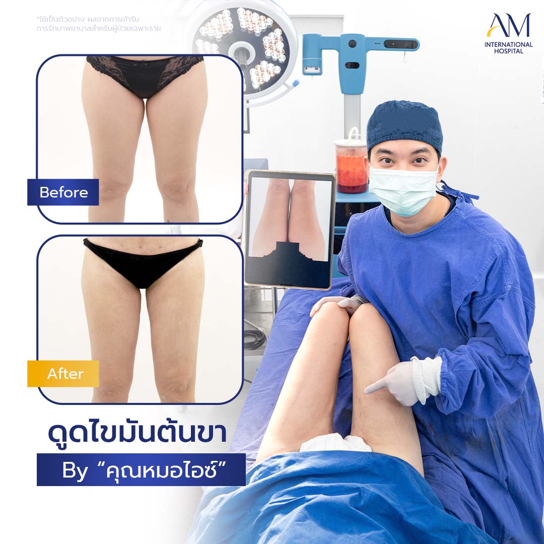 20260324-2024-02-21-สนใจดูดไขมัน-รีวิวโหดขา2-Balloon 2-แก้1-1-1