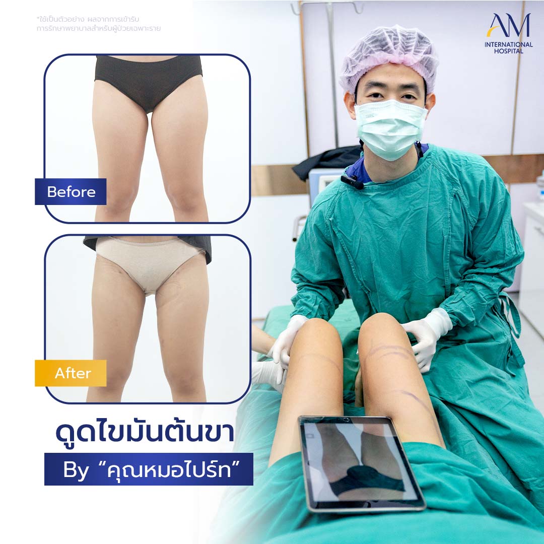 20260324-2024-02-21-สนใจดูดไขมัน-รีวิวโหดขา2-Balloon 2-แก้1-1-2