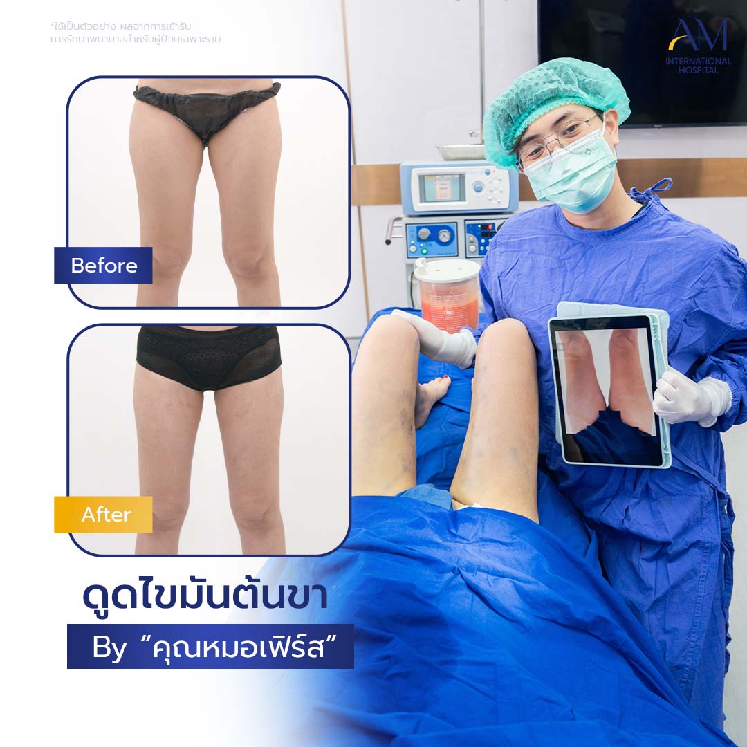 20260324-2024-02-21-สนใจดูดไขมัน-รีวิวโหดขา2-Balloon 2-แก้1-1-3