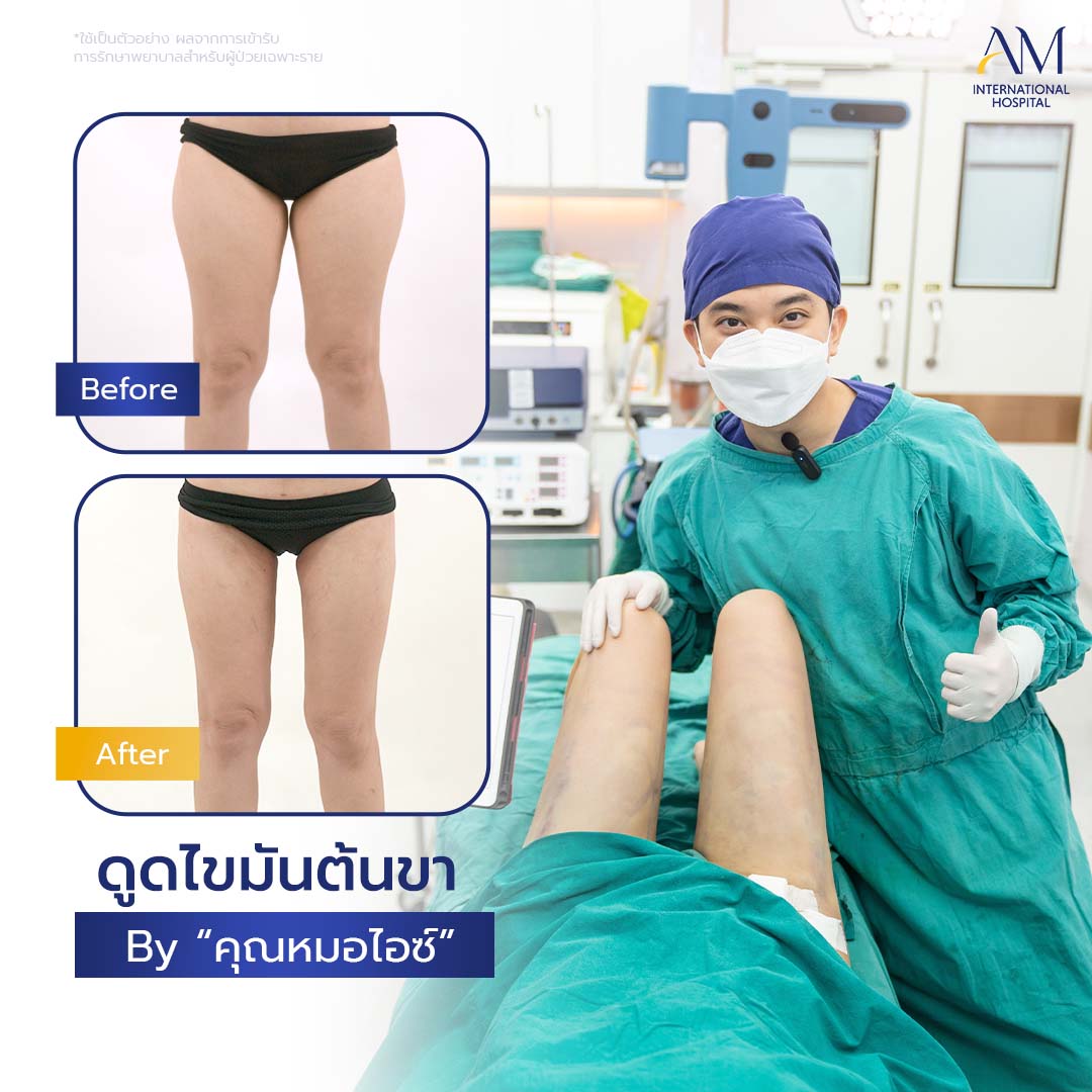 20260324-2024-02-21-สนใจดูดไขมัน-รีวิวโหดขา2-Balloon 2-แก้1-1-4