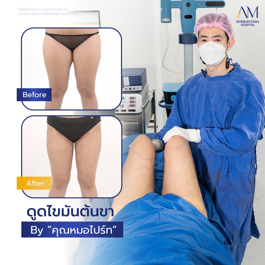 20260324-2024-02-21-สนใจดูดไขมัน-รีวิวโหดขา2-Balloon 2-แก้1-1-5