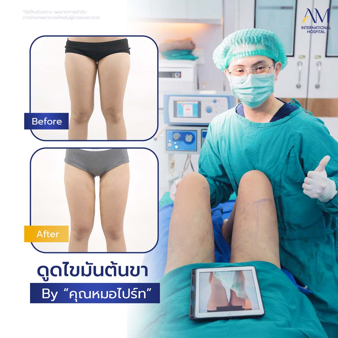 20260324-2024-02-21-สนใจดูดไขมัน-รีวิวโหดขา2-Balloon 2-แก้1-1-6