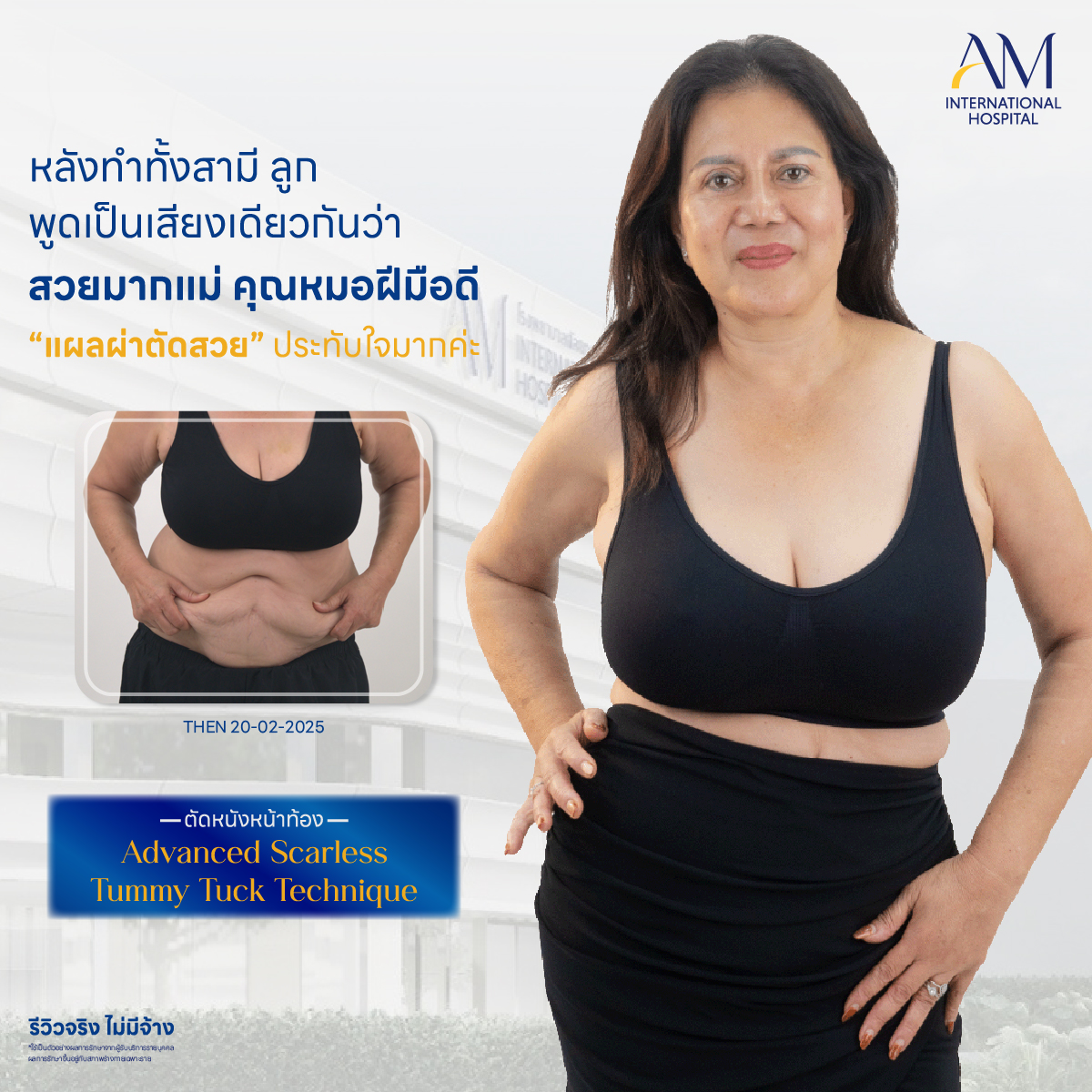 ตัดหนังหน้าท้อง รีวิว