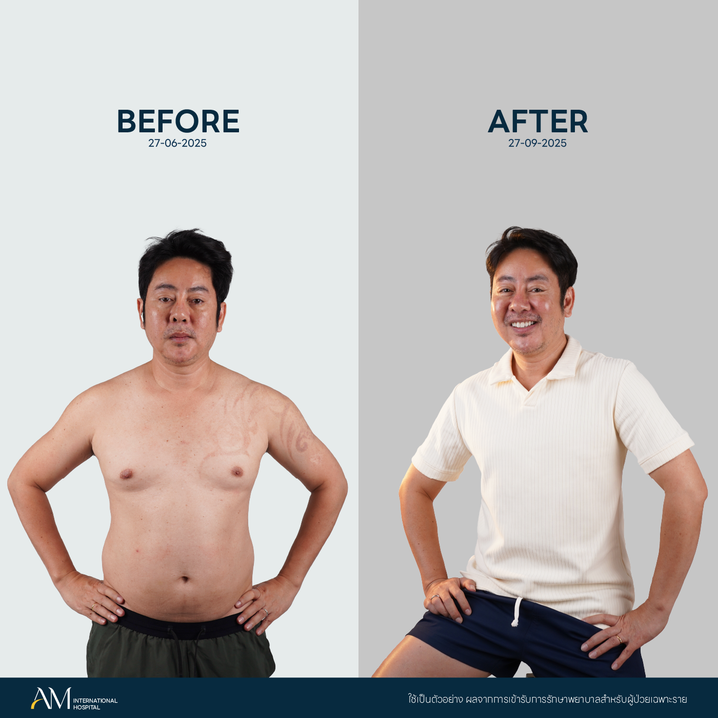 รีวิวตัดหน้าอกชาย ก่อน-หลังทำ