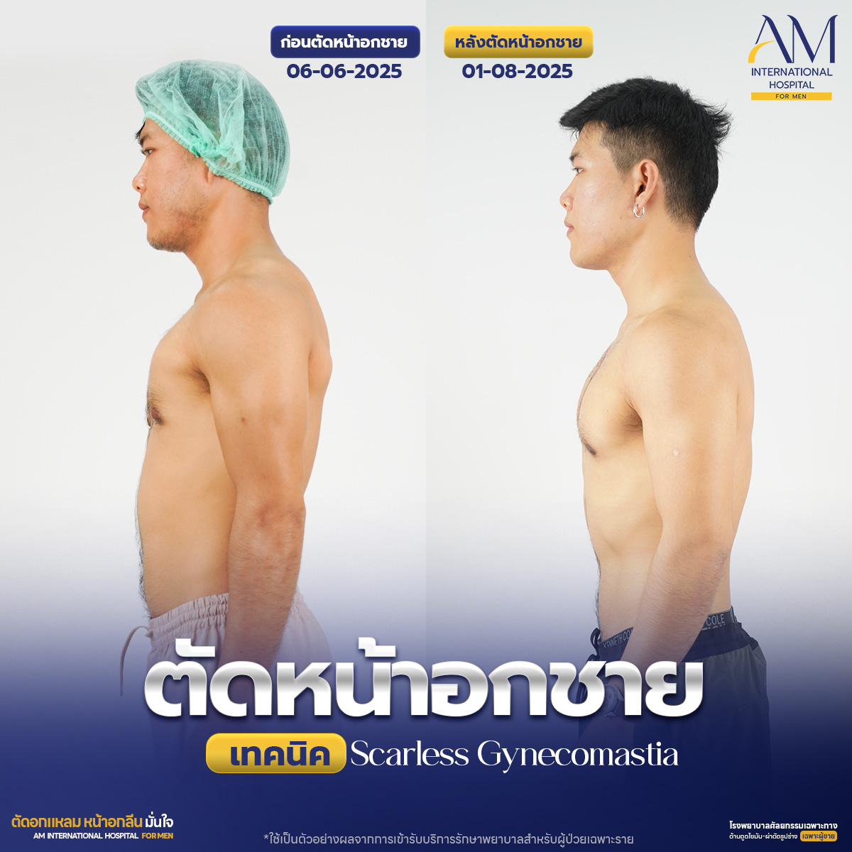 ก่อนและหลังตัดหน้าอกชาย คุณเบิร์ด