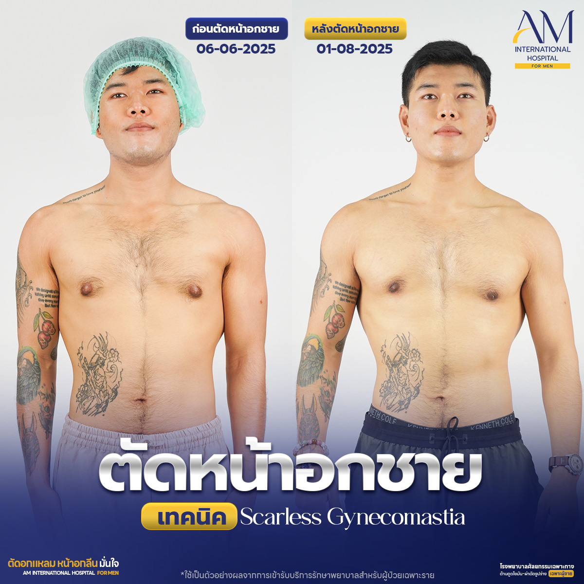 ก่อนและหลังตัดหน้าอกชาย คุณเบิร์ด