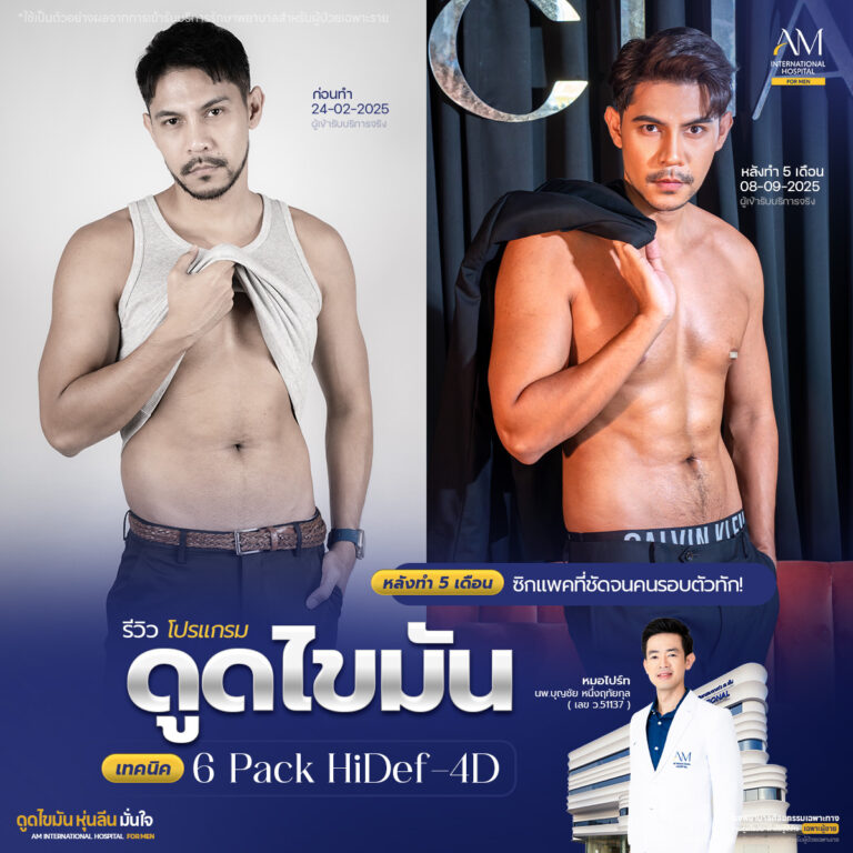 รีวิวดูดไขมันสร้างซิกแพค