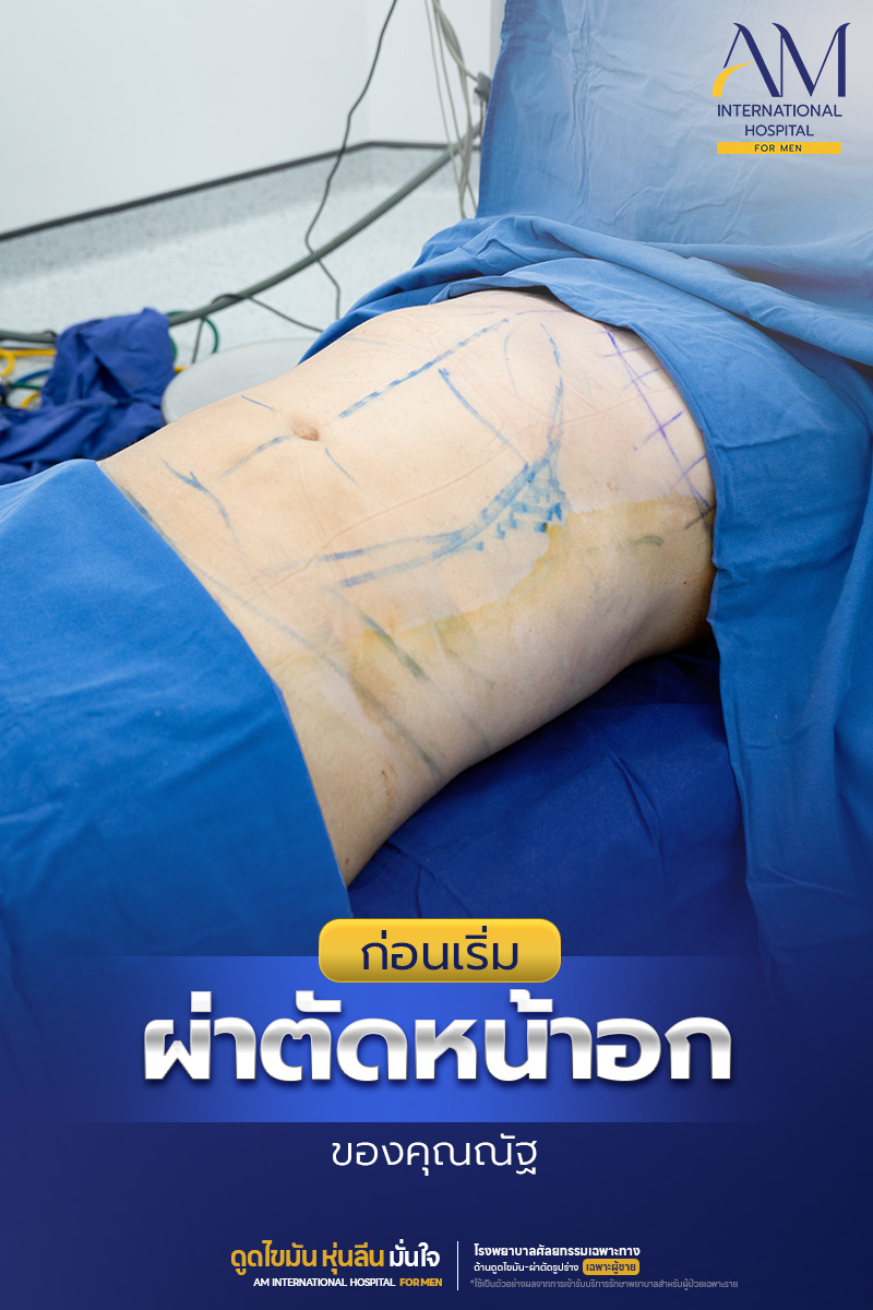 ขั้นตอนห้องผ่าตัดหน้าอกชาย AM International Hospital