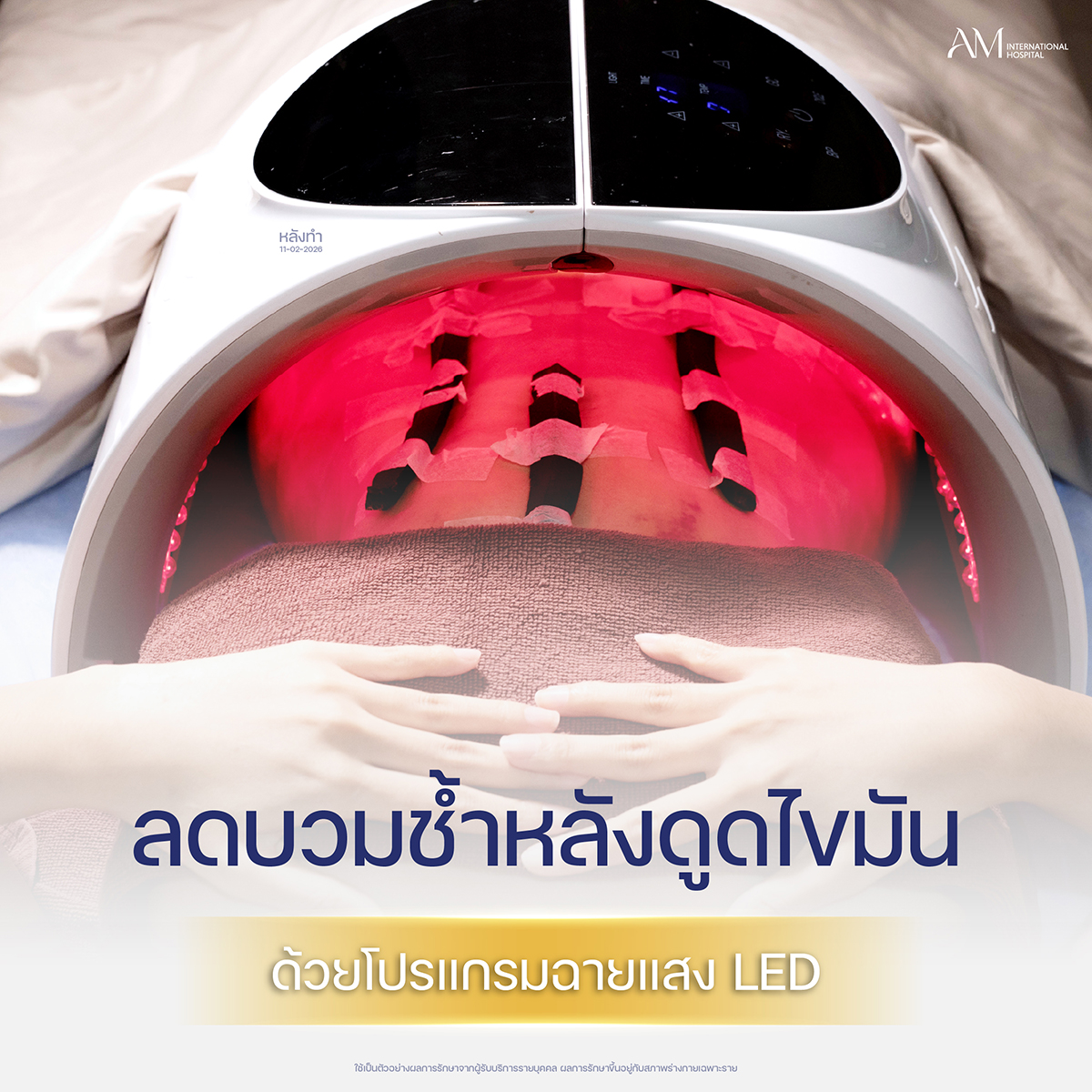 ฉายแสงลดบวม เคสคุณเจ้าเอย