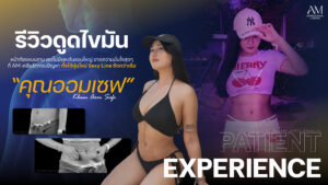 รีวิว ดูดไขมัน