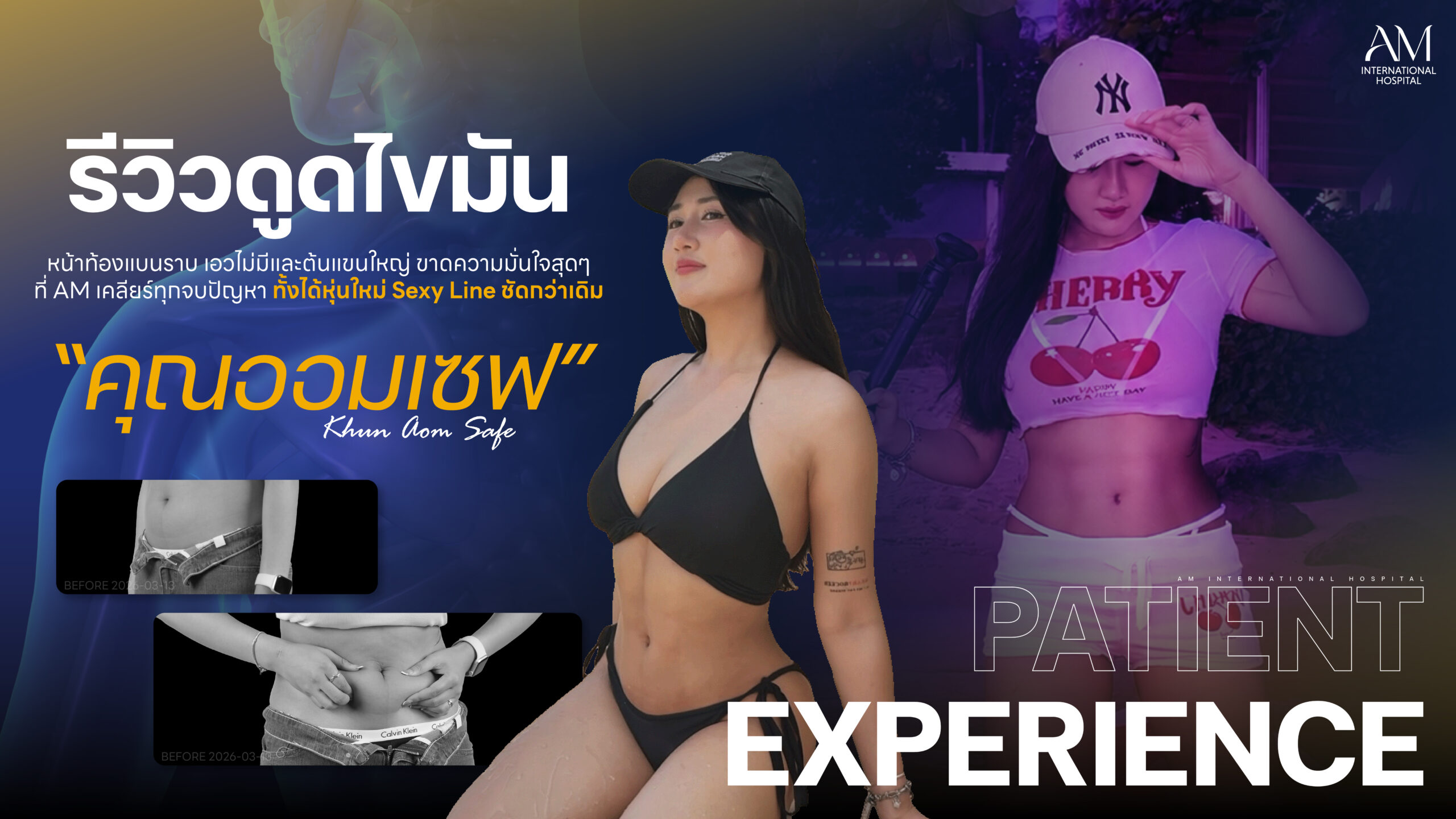 รีวิว ดูดไขมัน
