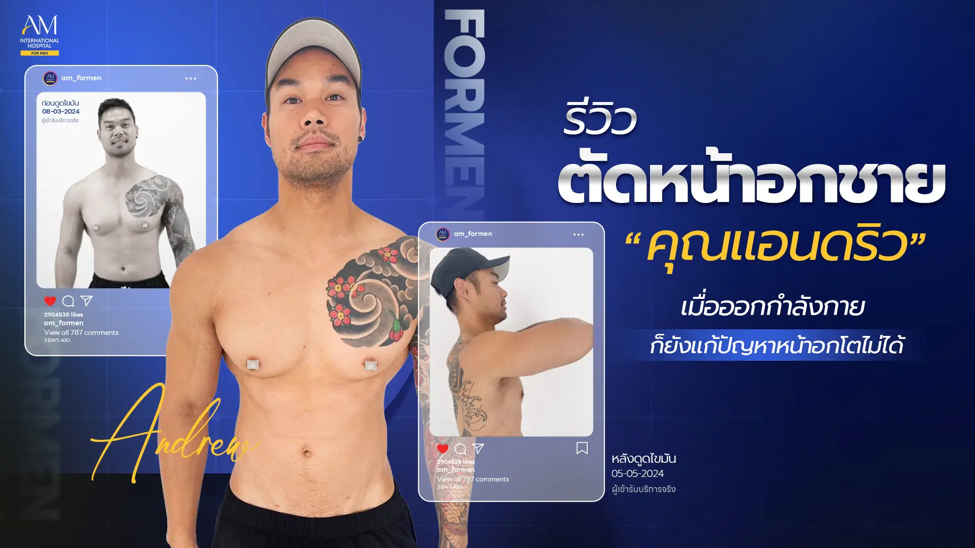 รีวิวตัดหน้าอกชาย