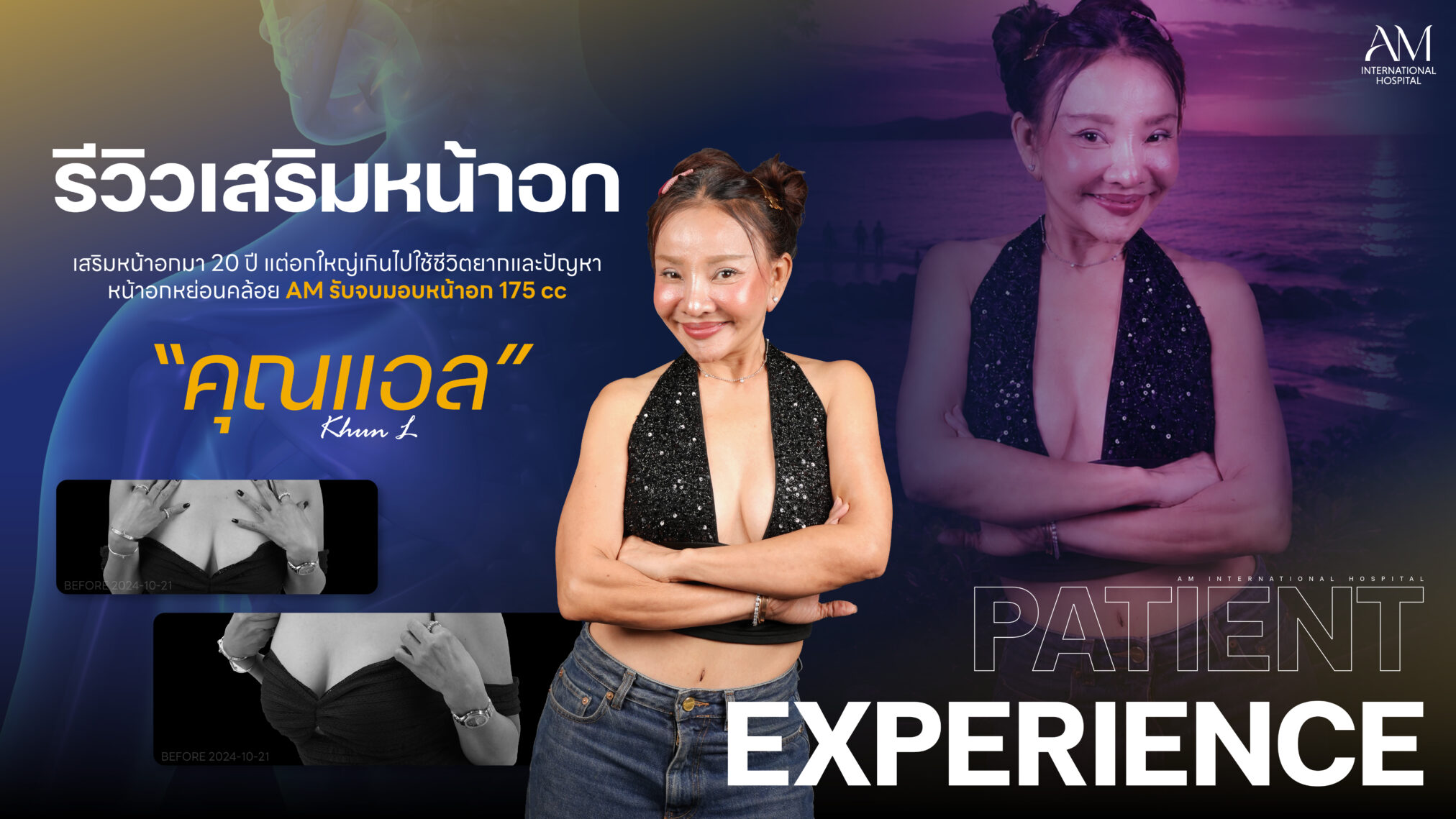 รีวิวเสริมหน้าอก